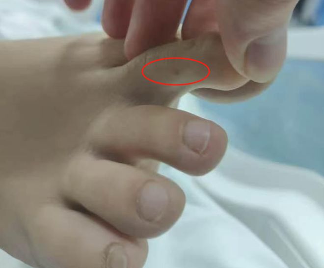 女子”死亡记录：曾诊断为不明生物咬伤(神经毒蛇) 等PG麻将胡了2试玩“三亚旅游被不明物咬伤身亡27岁(图4)